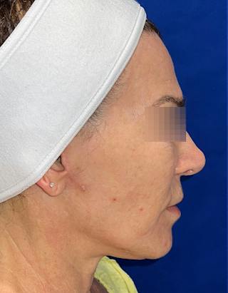Face Lift Before & After Gallery - Patient 242829 - Image 4