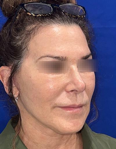 Face Lift Before & After Gallery - Patient 242829 - Image 1