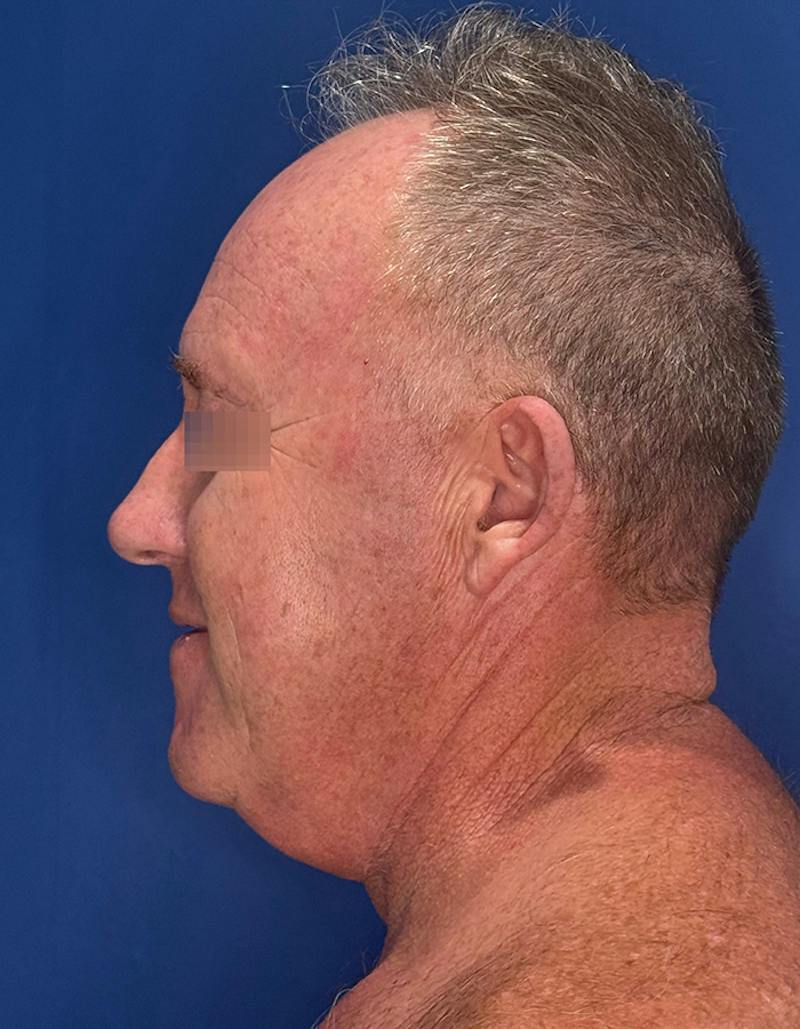 Face Lift Before & After Gallery - Patient 167892 - Image 11