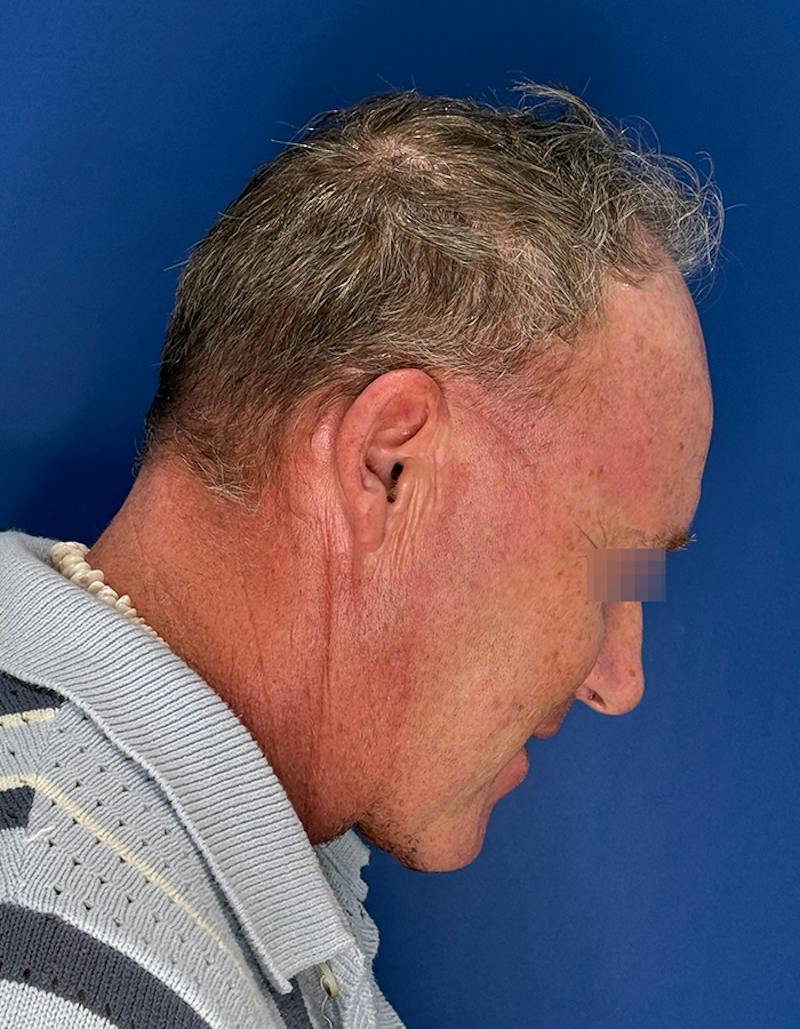 Face Lift Before & After Gallery - Patient 167892 - Image 8