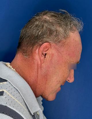 Face Lift Before & After Gallery - Patient 167892 - Image 8