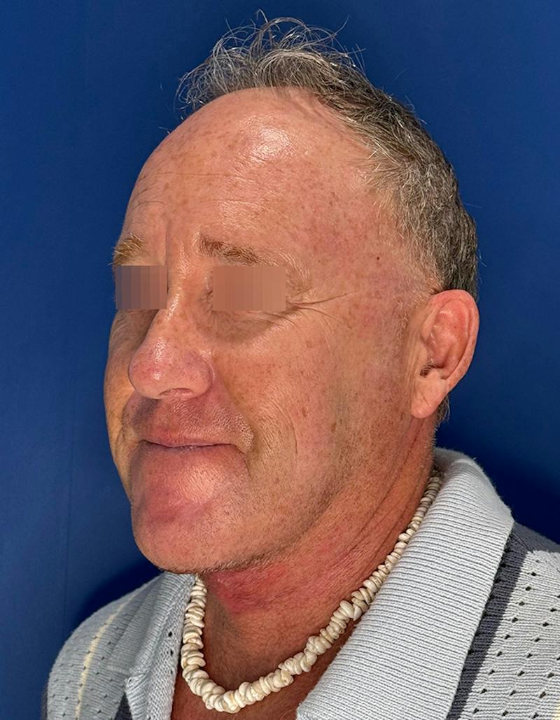 Face Lift Before & After Gallery - Patient 167892 - Image 10