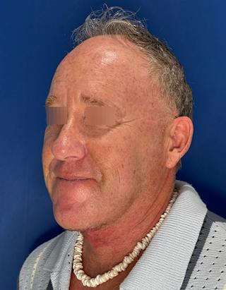 Face Lift Before & After Gallery - Patient 167892 - Image 10