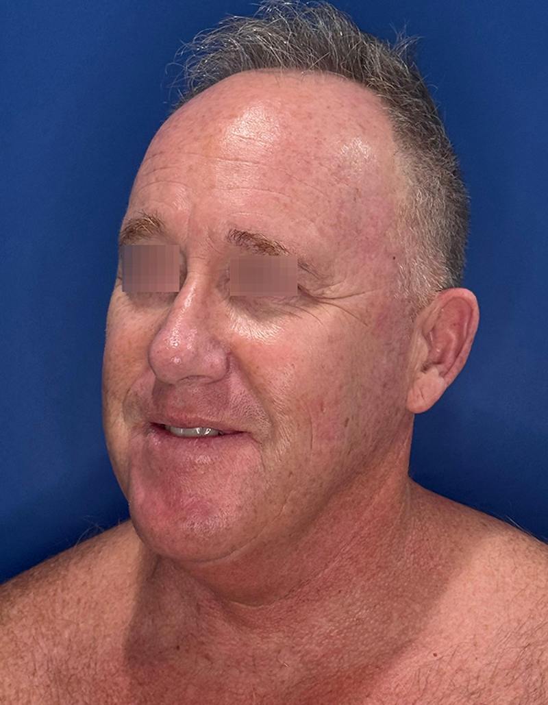 Face Lift Before & After Gallery - Patient 167892 - Image 9