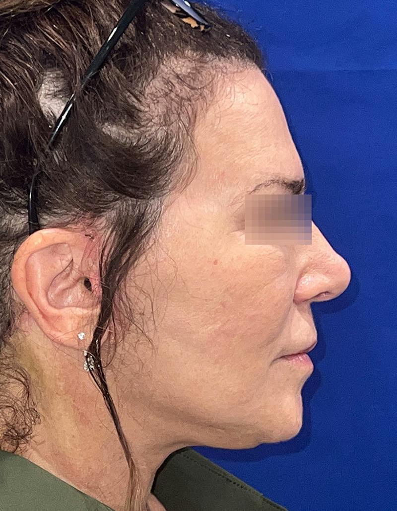 Face Lift Before & After Gallery - Patient 242829 - Image 3