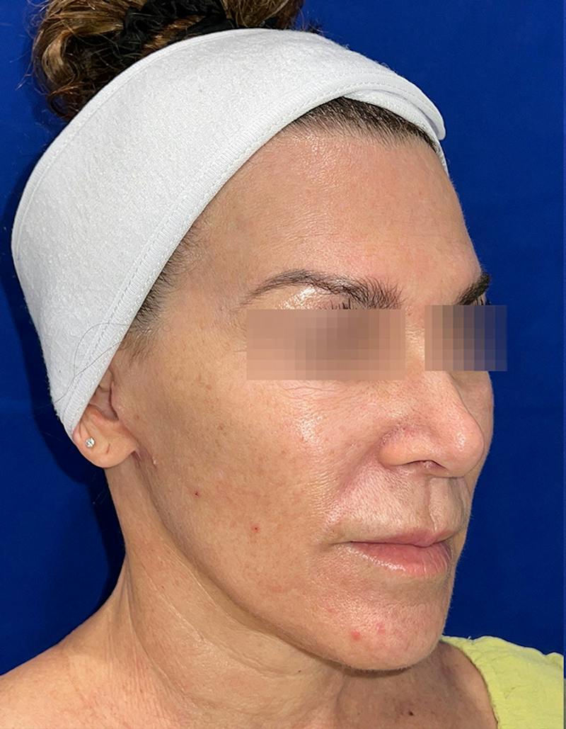 Face Lift Before & After Gallery - Patient 242829 - Image 2
