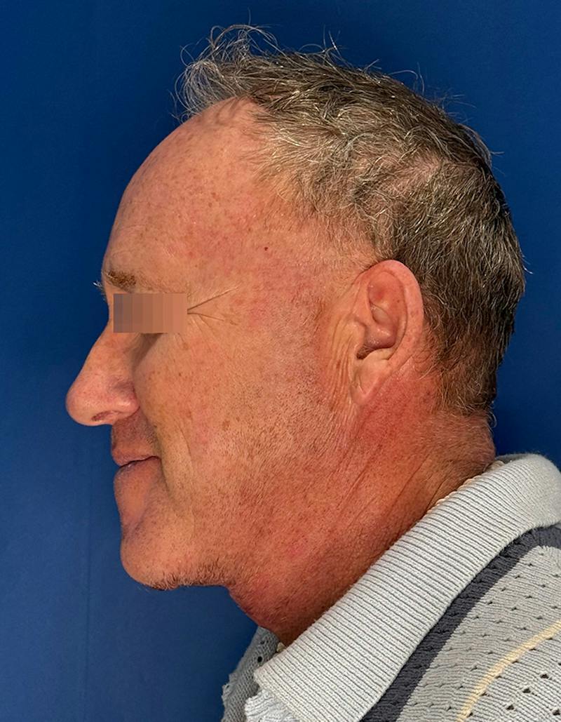 Face Lift Before & After Gallery - Patient 167892 - Image 12