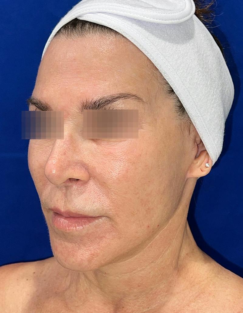 Face Lift Before & After Gallery - Patient 242829 - Image 8