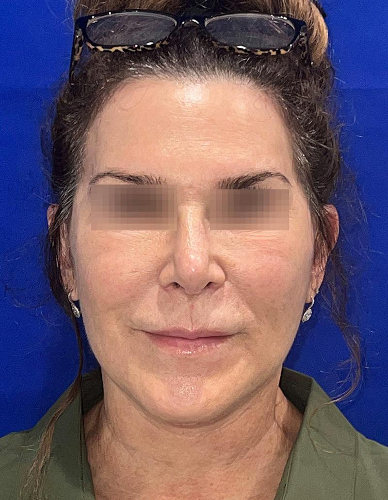 Face Lift Before & After Gallery - Patient 242829 - Image 5