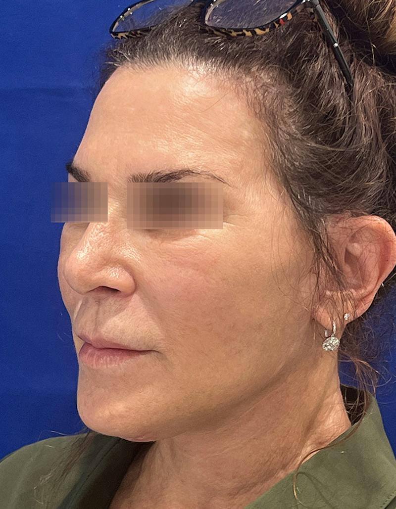 Face Lift Before & After Gallery - Patient 242829 - Image 7