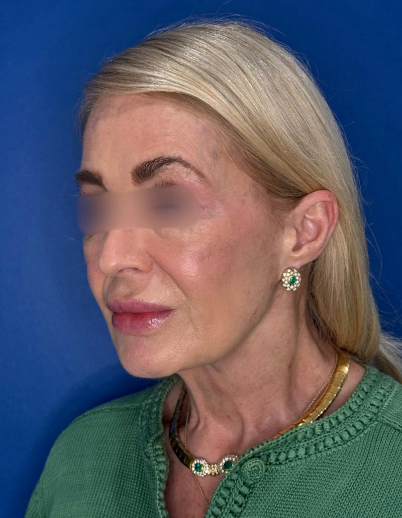 Brow Lift Before & After Gallery - Patient 134846 - Image 3
