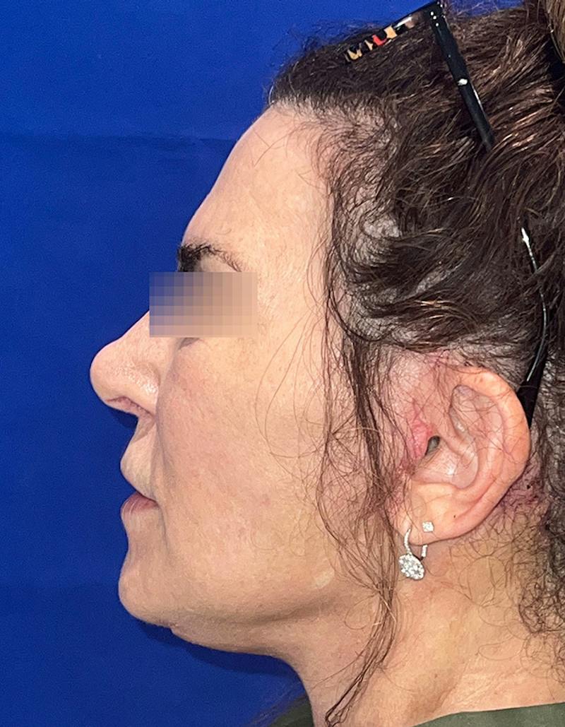 Face Lift Before & After Gallery - Patient 242829 - Image 9