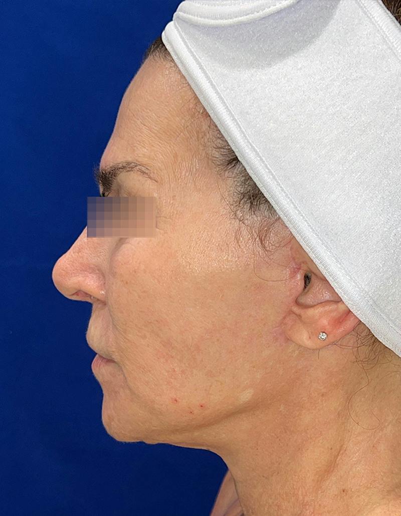Face Lift Before & After Gallery - Patient 242829 - Image 10