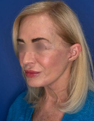 Brow Lift Before & After Gallery - Patient 134846 - Image 4