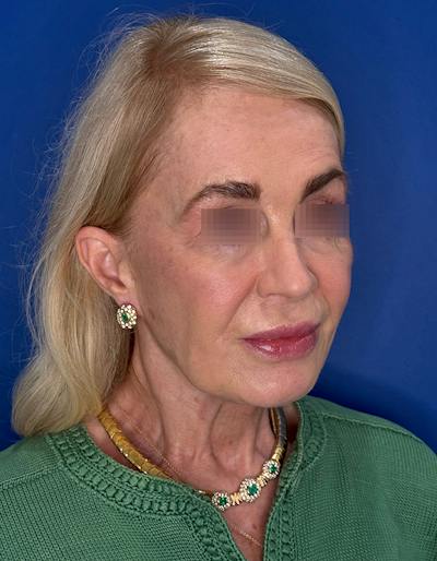 Face Lift Before & After Gallery - Patient 147123 - Image 1