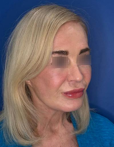 Face Lift Before & After Gallery - Patient 147123 - Image 2