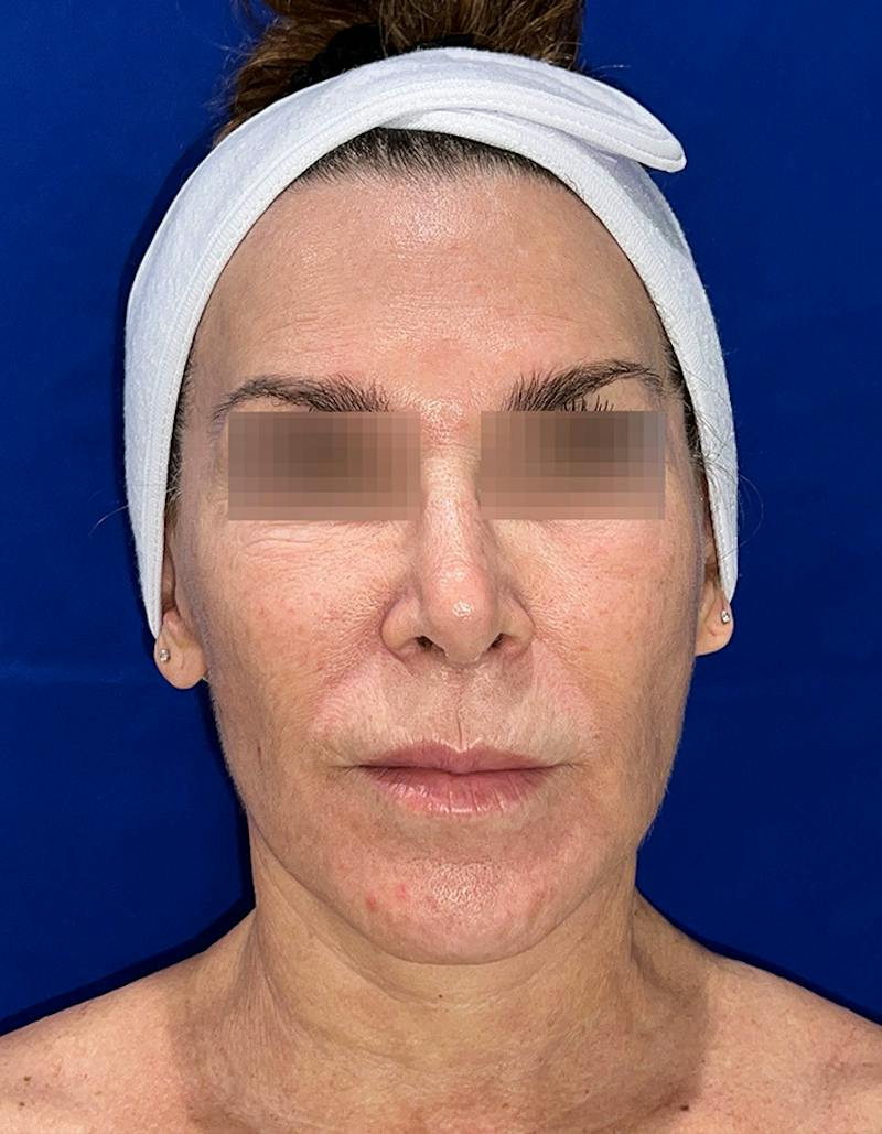 Face Lift Before & After Gallery - Patient 242829 - Image 6