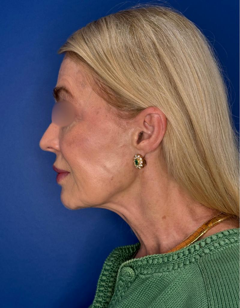 Brow Lift Before & After Gallery - Patient 134846 - Image 5