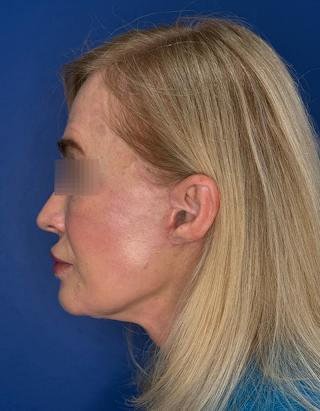 Face Lift Before & After Gallery - Patient 147123 - Image 10