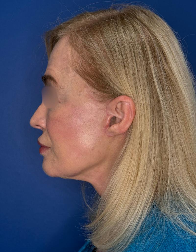Brow Lift Before & After Gallery - Patient 134846 - Image 6