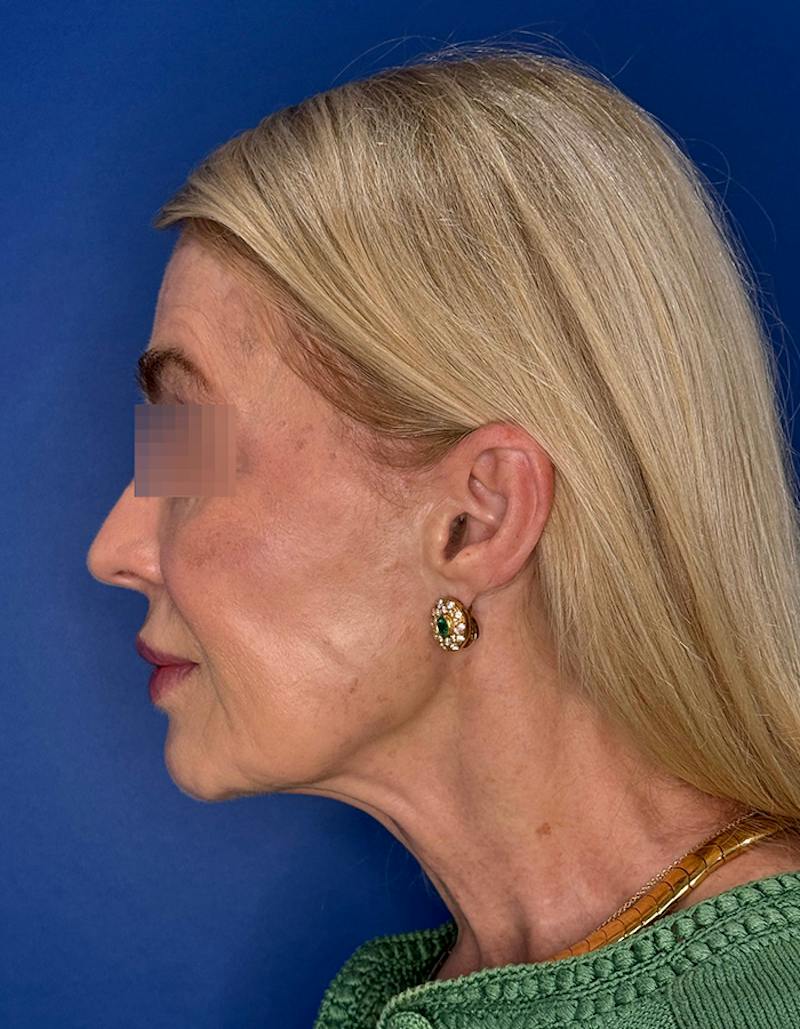 Face Lift Before & After Gallery - Patient 147123 - Image 9