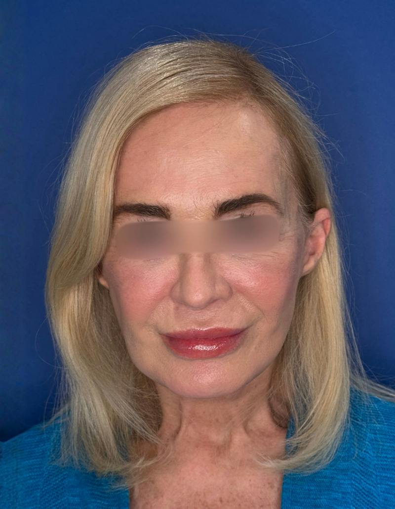 Brow Lift Before & After Gallery - Patient 134846 - Image 2