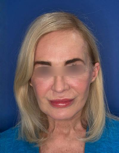 Laser Resurfacing Before & After Gallery - Patient 404816 - Image 2