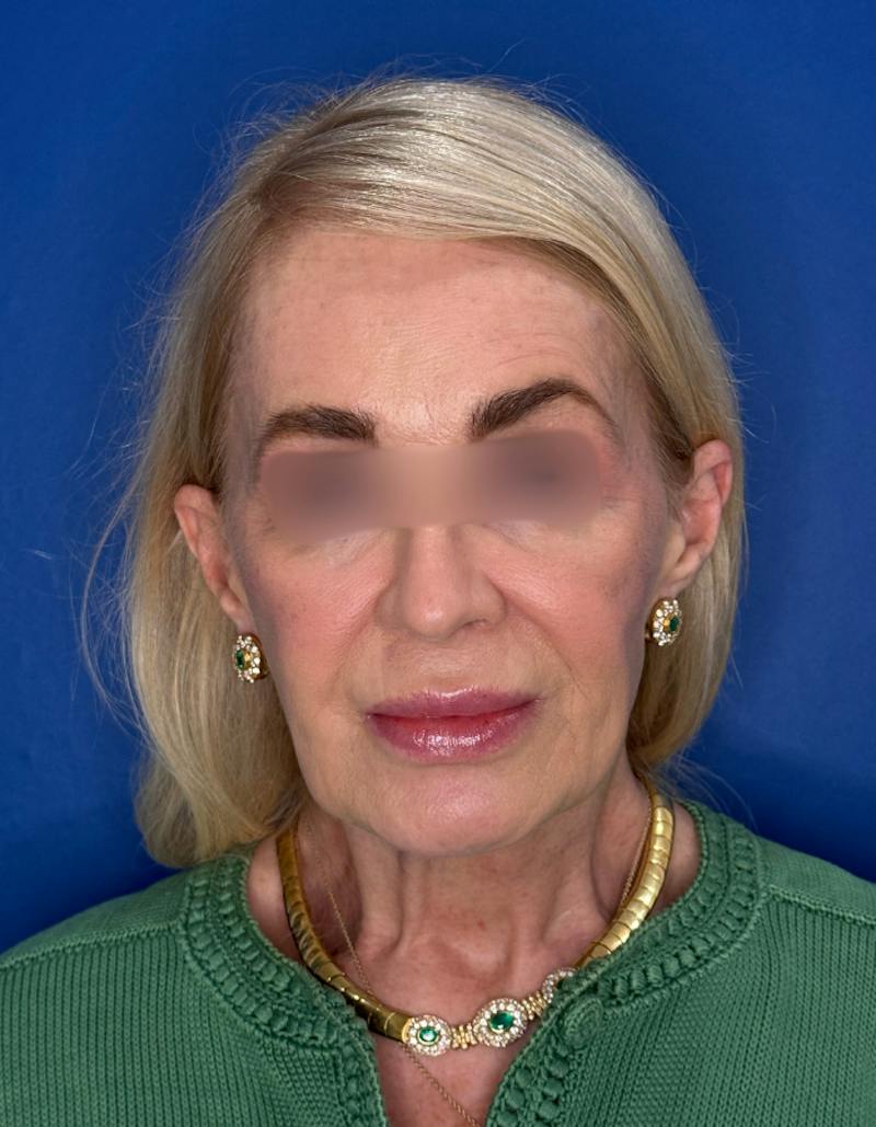 Brow Lift Before & After Gallery - Patient 134846 - Image 1