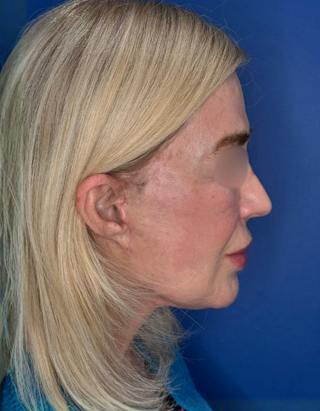 Brow Lift Before & After Gallery - Patient 134846 - Image 10