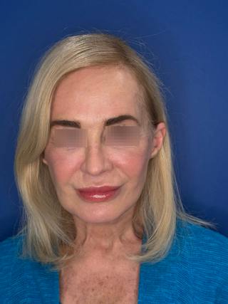 Face Lift Before & After Gallery - Patient 147123 - Image 6