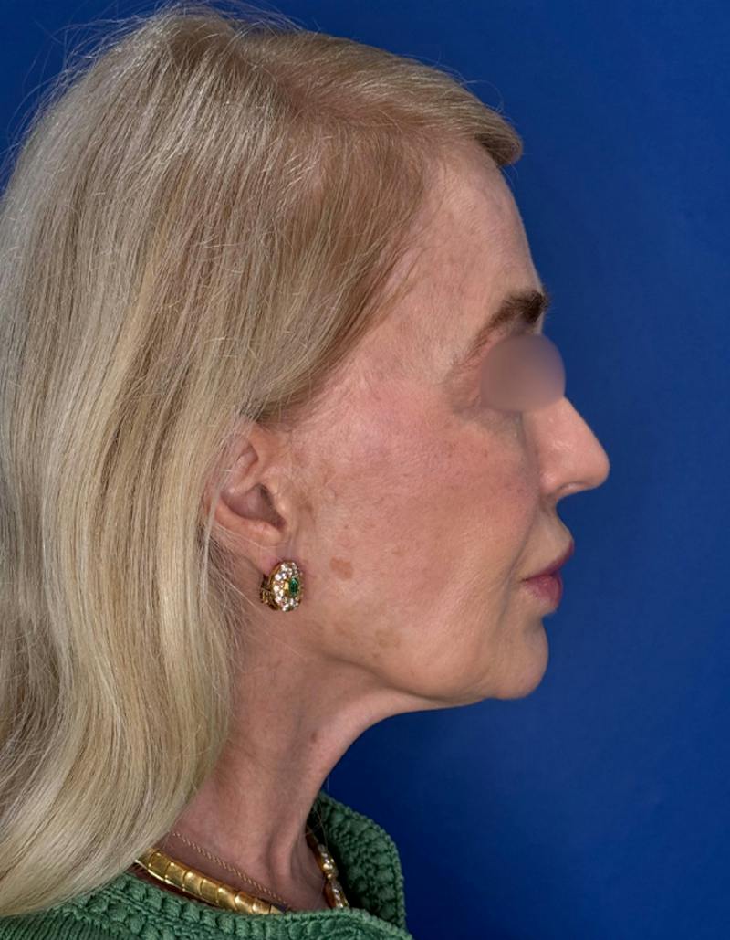 Brow Lift Before & After Gallery - Patient 134846 - Image 9
