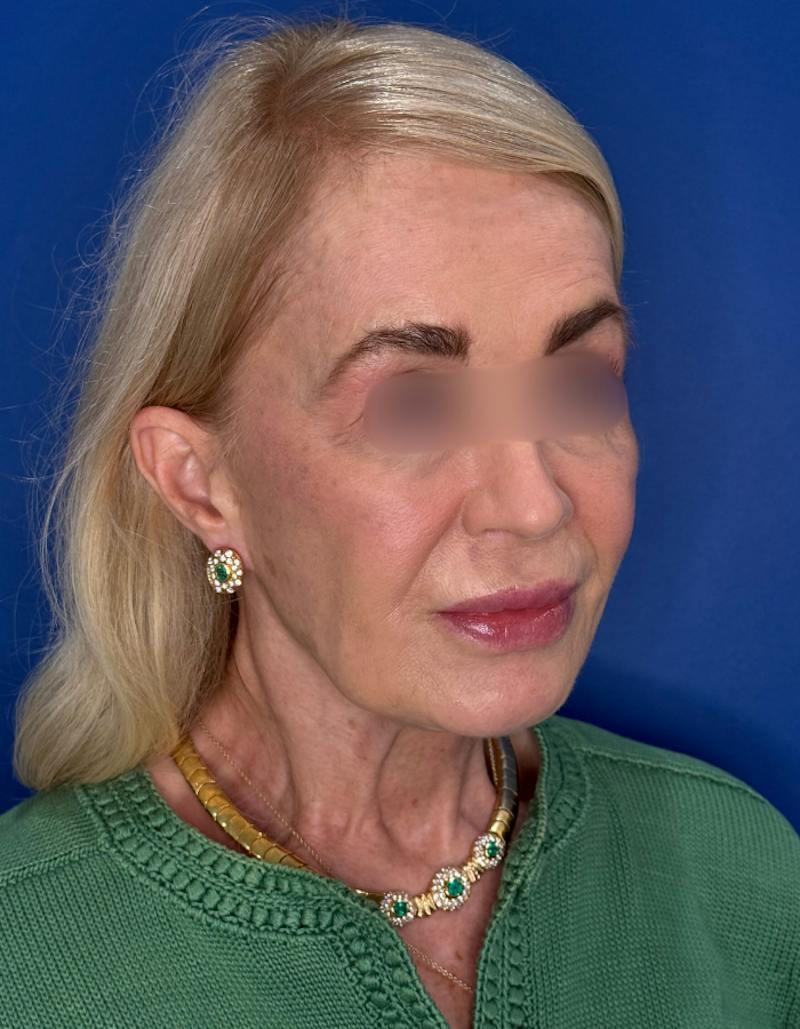 Brow Lift Before & After Gallery - Patient 134846 - Image 7