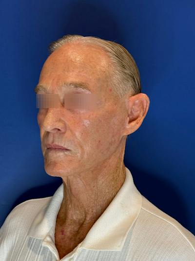 Brow Lift Before & After Gallery - Patient 212623 - Image 2