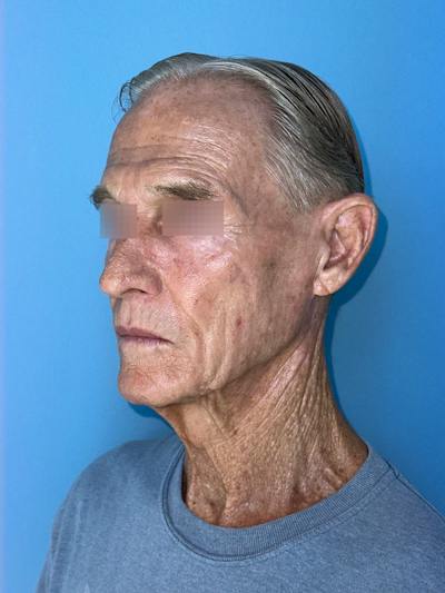 Brow Lift Before & After Gallery - Patient 212623 - Image 1