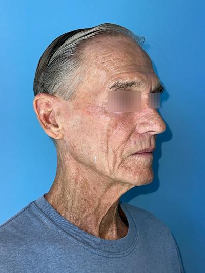 Face Lift Before & After Gallery - Patient 249179 - Image 1