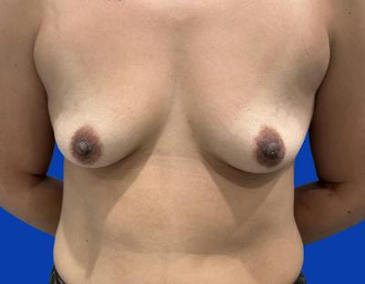Breast Augmentation Before & After Gallery - Patient 916601 - Image 1