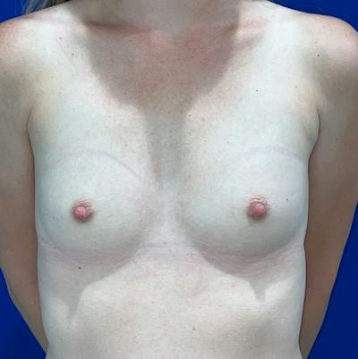 Breast Augmentation Before & After Gallery - Patient 325708 - Image 1