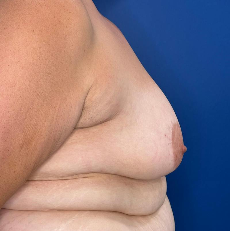 Breast Augmentation Before & After Gallery - Patient 306381 - Image 5