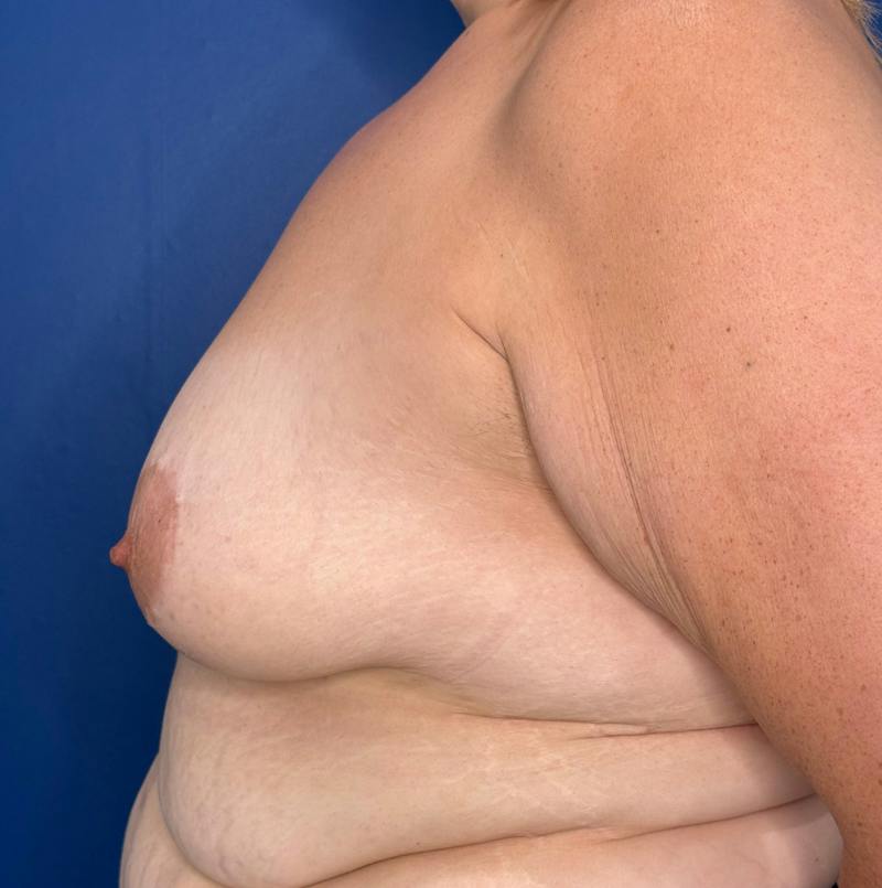 Breast Augmentation Before & After Gallery - Patient 306381 - Image 9