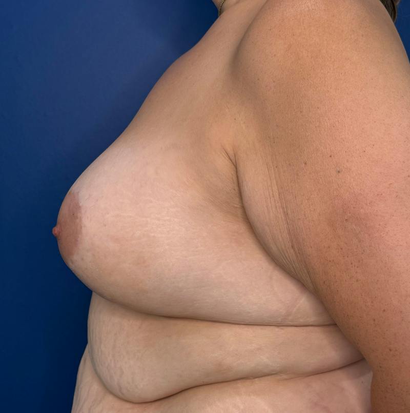 Breast Augmentation Before & After Gallery - Patient 306381 - Image 10