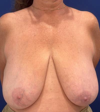 Breast Lift Before & After Gallery - Patient 106700 - Image 1