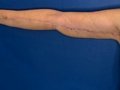 Arm Lift Before & After Gallery - Patient 303342 - Image 2