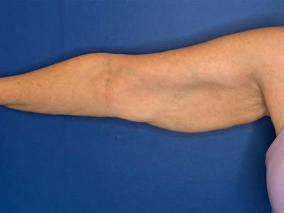 Arm Lift Before & After Gallery - Patient 303342 - Image 1