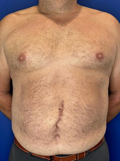 Tummy Tuck Before & After Gallery - Patient 831347 - Image 1