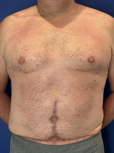 Tummy Tuck Before & After Gallery - Patient 831347 - Image 2