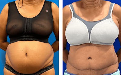 Abdominoplasty Before & After Gallery - Patient 347091 - Image 1