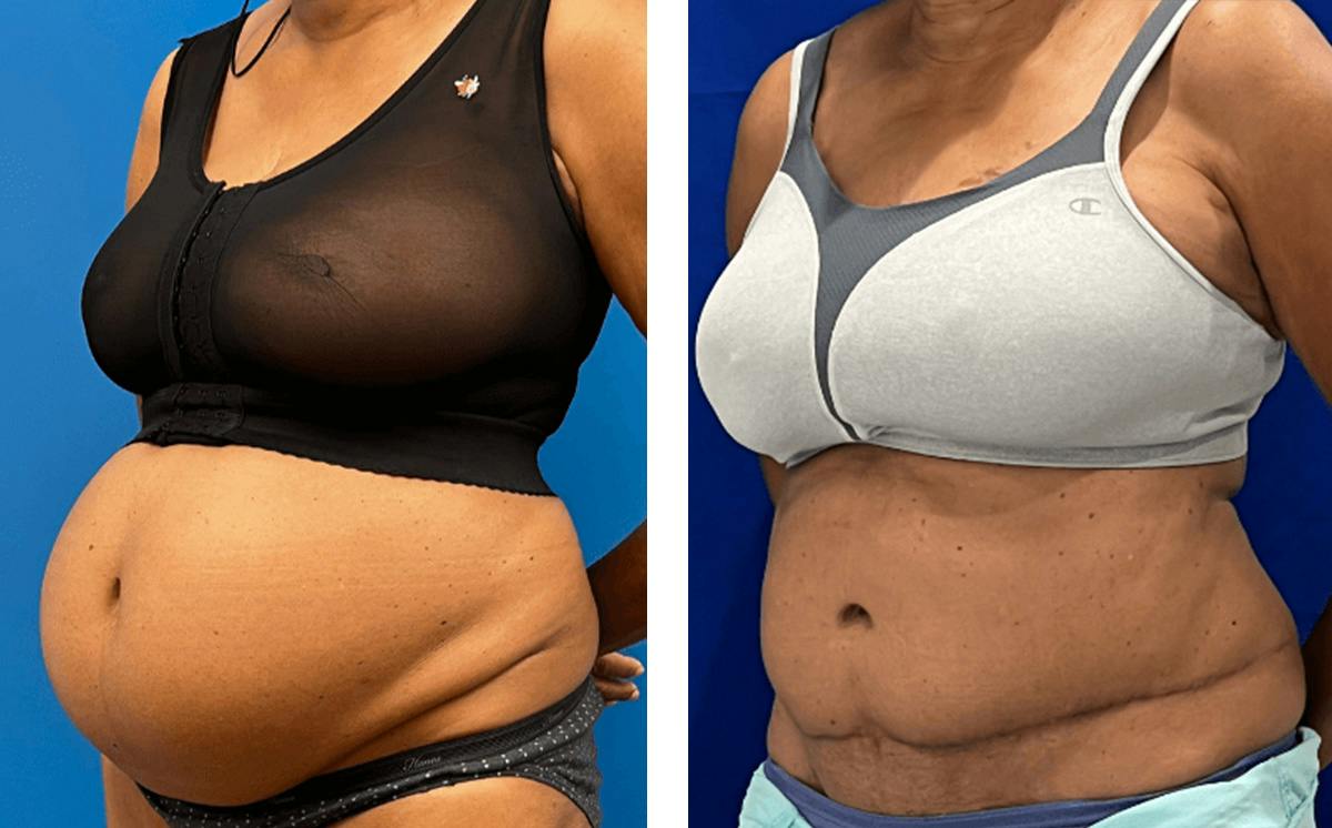 Abdominoplasty Before & After Gallery - Patient 347091 - Image 2