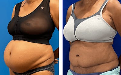 Abdominoplasty Before & After Gallery - Patient 347091 - Image 2