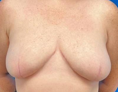 Breast Reduction Before & After Gallery - Patient 273273 - Image 2