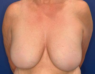 Breast Lift Before & After Gallery - Patient 215833 - Image 1